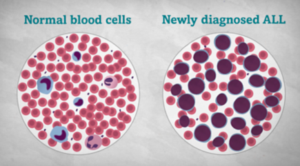 急性淋巴细胞白血病 (ALL) 图像数据集