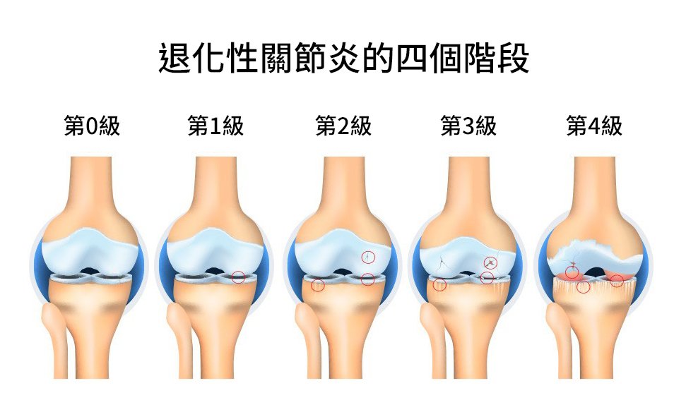 具有严重程度分级的膝骨关节炎数据集