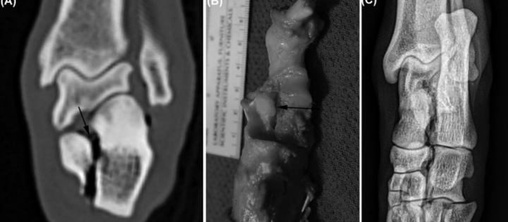 使用 X 射线检测骨折