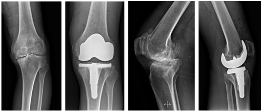 膝盖 X 光检查 - 骨关节炎的 4 个阶段