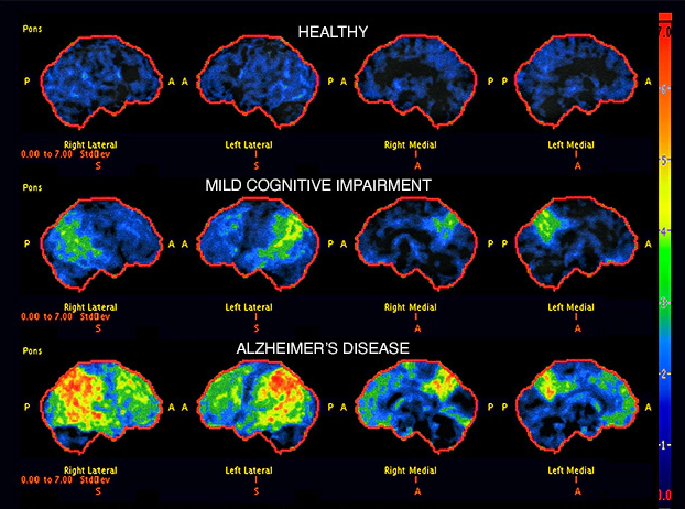 阿尔茨海默病数据集（4 类图像）