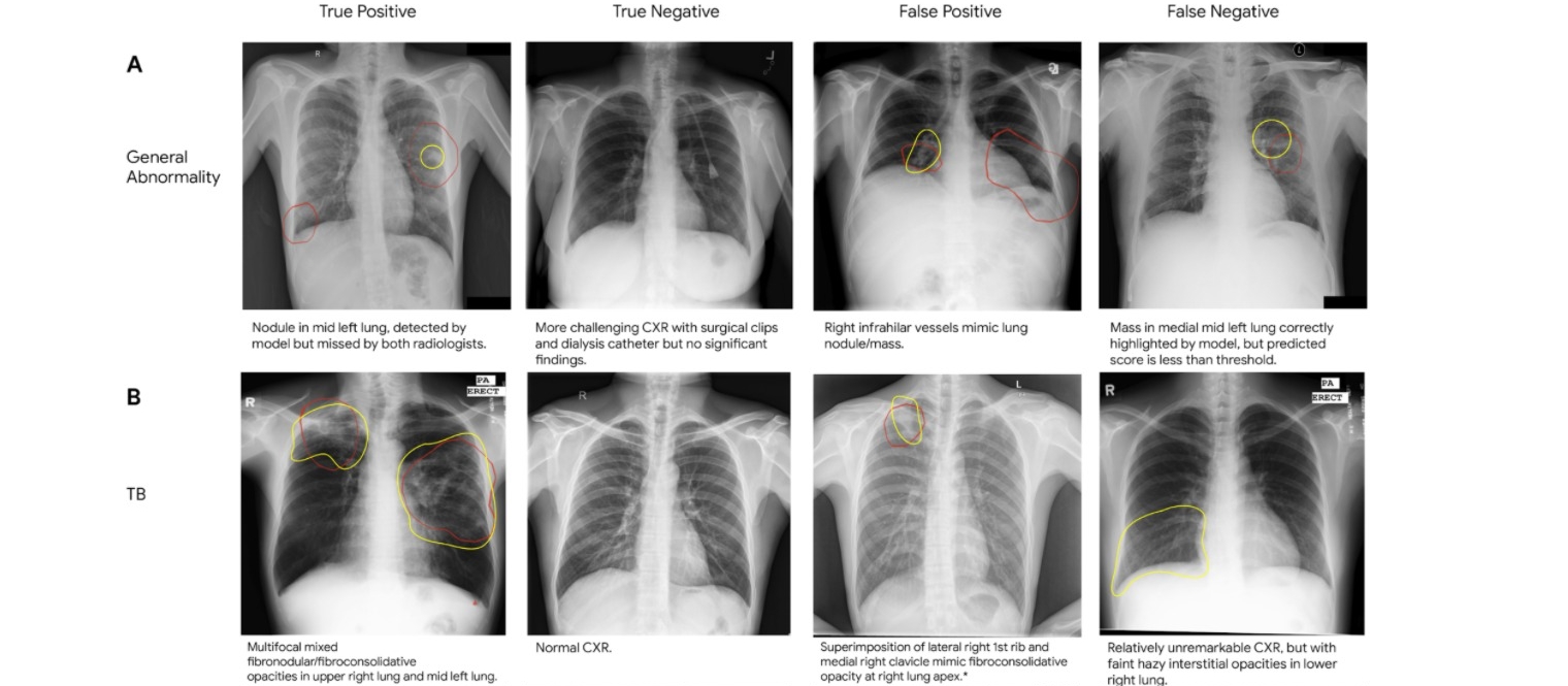肺炎胸部 X 光数据集