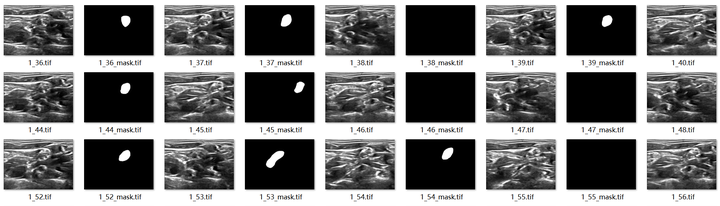 乳腺超声图像数据集