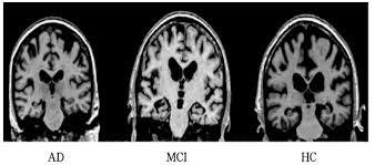 阿尔茨海默病 MRI 预处理数据集