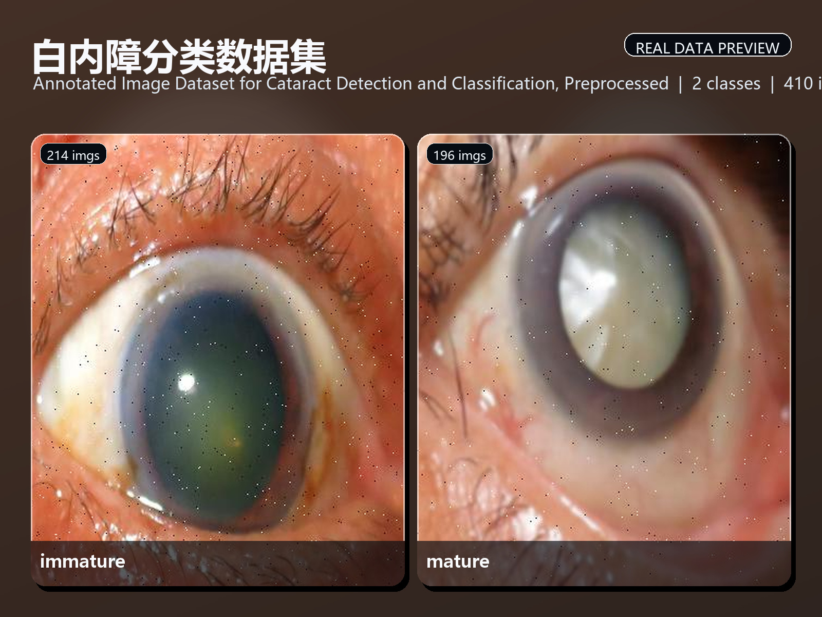 白内障分类数据集